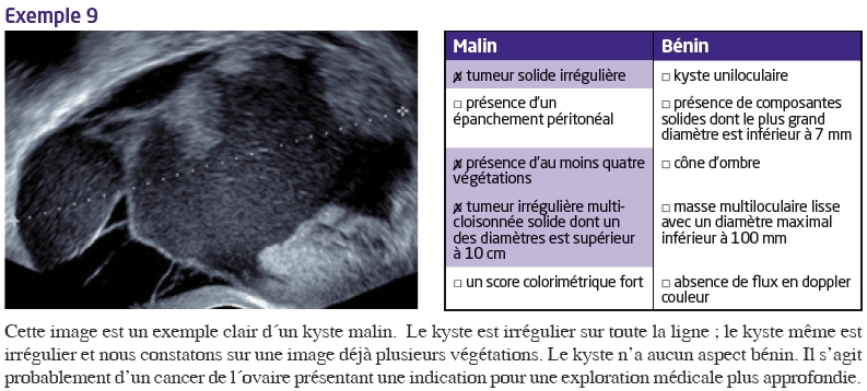 Imagerie des tumeurs ovariennes, du bénin au malin : les signes d ...
