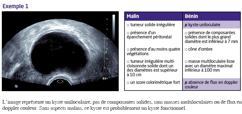 Imagerie des tumeurs ovariennes, du bénin au malin : les signes d ...