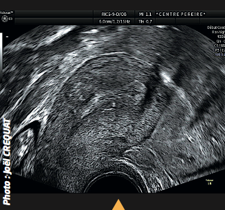 L’image 1 montre un utérus de volume normal et un endomètre régulier sans image gestationnelle intra-cavitaire. Or à ce niveau d’hCG, une grossesse intra-utérine est visible dans la très grande majorité des cas.