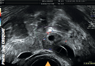 L’image 2 montre l’annexe droite. Il existe d’une part 2 petites images ovariennes vraisemblablement folliculaires et d’autre part, en dehors, une image d’environ 10 mm, formée d’un centre transonore et d’une couronne échogène vascularisée dont on ne peut pas préciser la nature.