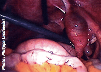 L’image 4 permet de visualiser la trompe droite déformée par un nodule de la taille d’un grain de raisin, confirmant la localisation intra-tubaire de la grossesse.