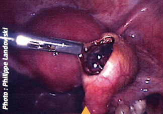 L’image 5 est réalisée après incision de la paroi tubaire avant extraction de la GEU.