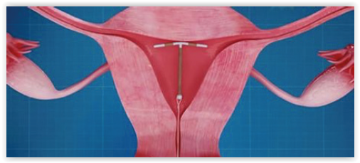 Schéma représentant un DIU dans la cavité utérine