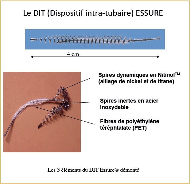 Le DIT (Disposi,f intra-tubaire) ESSURE