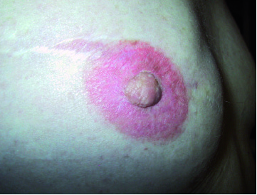 Cancer du sein : une tumeur identifiée lors de sa réduction mammaire