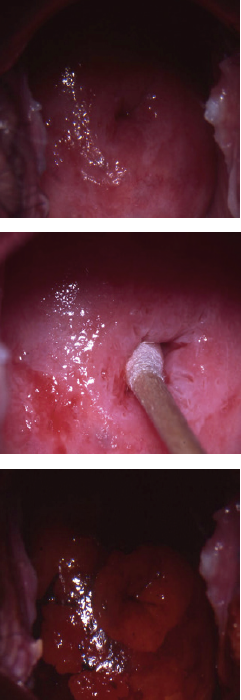 Lesion hpv traitement. Ginecologie MGVI LR Traitement lesion papillomavirus
