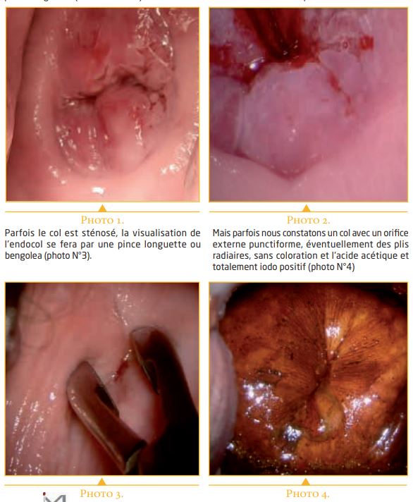 papillomavirus et prise de poids