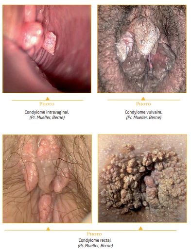 Condylomes acuminés : prise en charge et options thérapeutiques ...