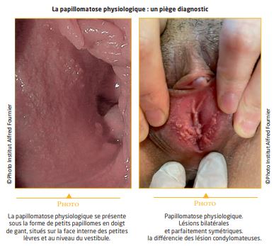 Condylomes acuminés : prise en charge et options thérapeutiques ...