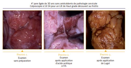 hpv et la grossesse