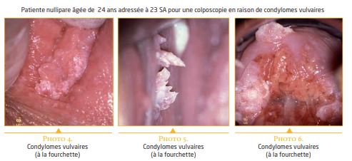 papillomavirus de la femme enceinte)