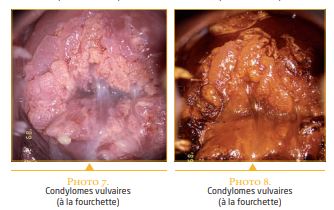 Pathologie HPV au cours de la grossesse – REVUE GENESIS