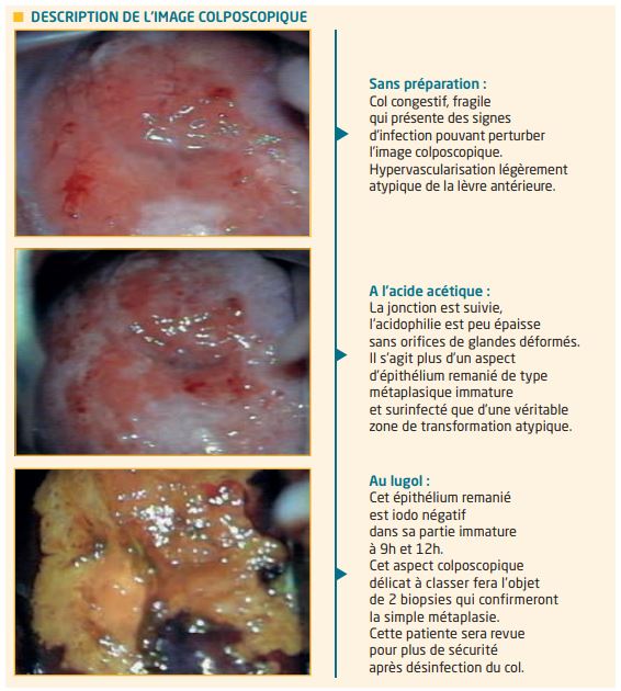 hpv faux positif papilloma al labbro