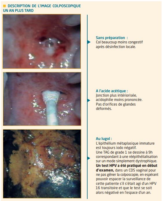 hpv positif biopsie