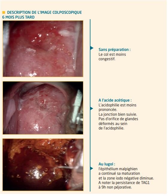 papillomavirus faux positif)