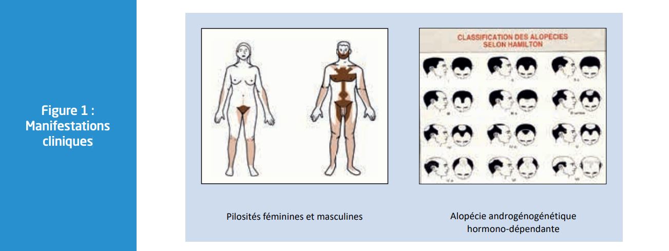 L'hyperandrogénisme : comprendre et traiter après l'abandon de l ...