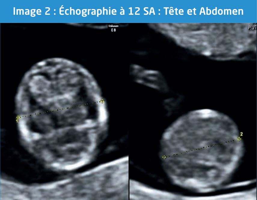 Echographie de grossesse à 22 semaines d'aménorrhée 