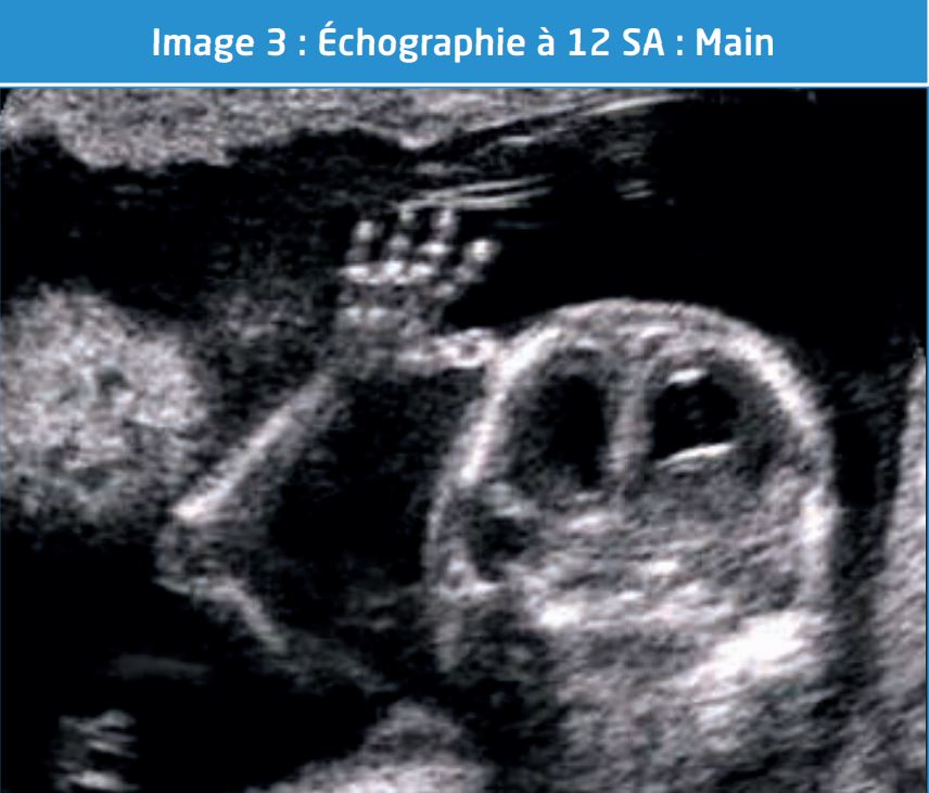 Echographie de grossesse morphologique du DEUXIEME TRIMESTRE sans  ordonnance - Centre de santé du Marais